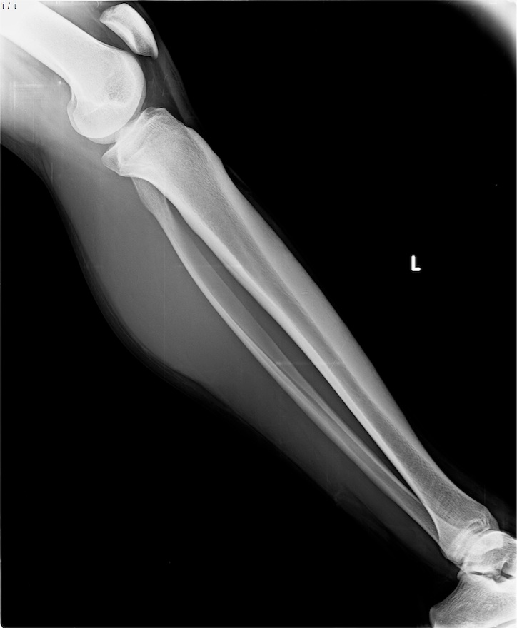 Preop radyografi 4